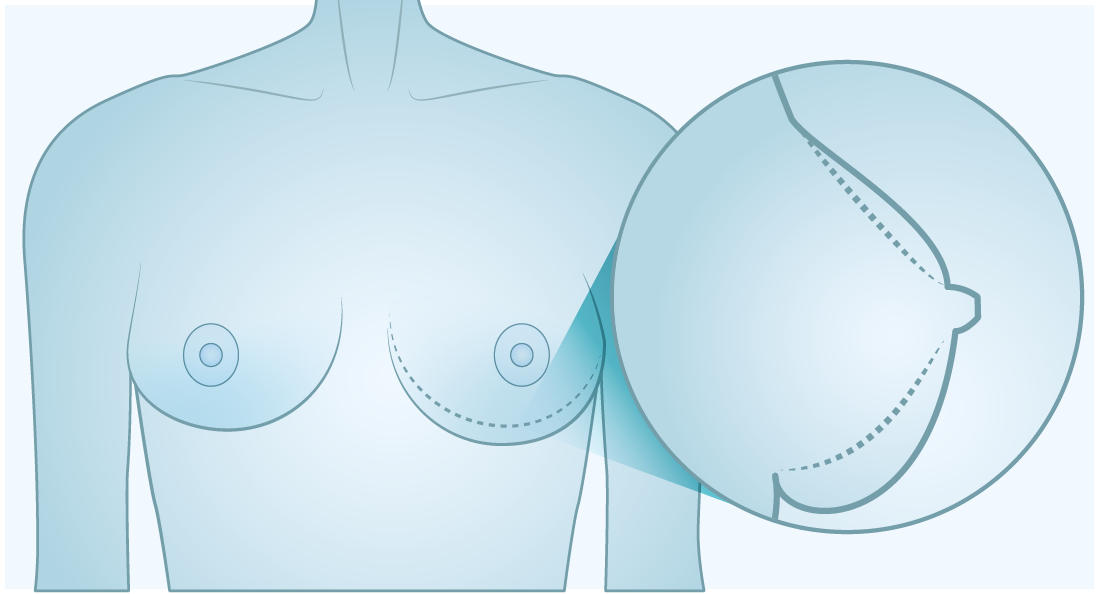 abnormalSizeGrowth