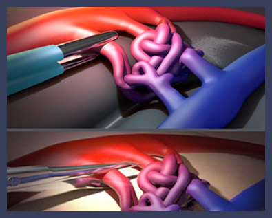 Surgical illustration Brain AVM (arteriovenous malformation)
